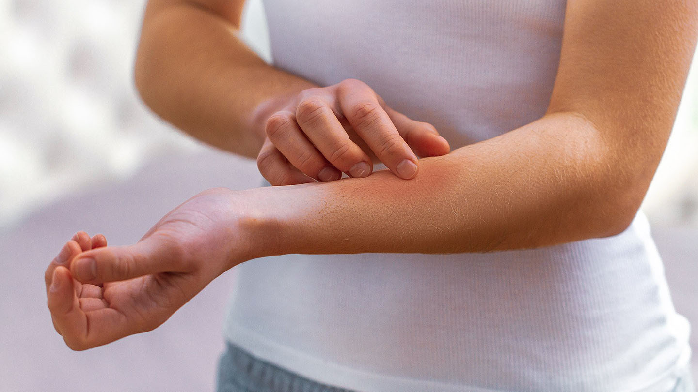 Alergije in izpuščaji so pogost simptom padca odpornosti.